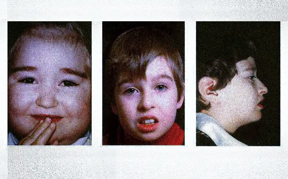 سندروم کوهن گیبسون